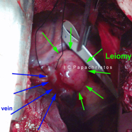 oesophagleiomyoma6.jpg