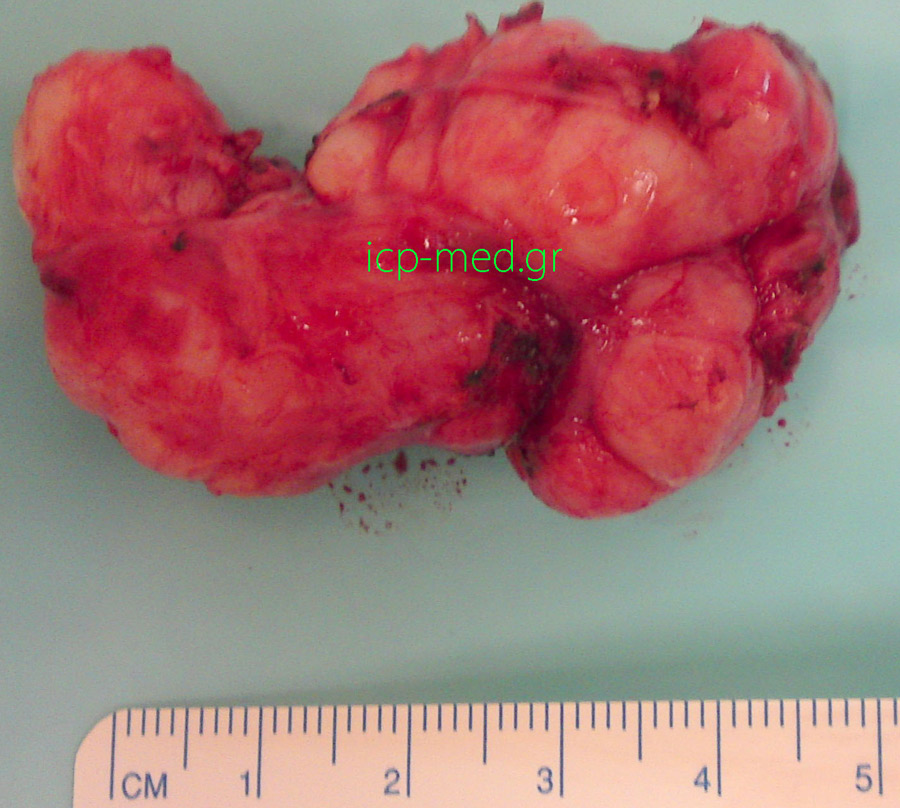 7.Specimen: oesophageal leiomyoma resected