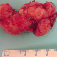 oesophagleiomyoma7.jpg