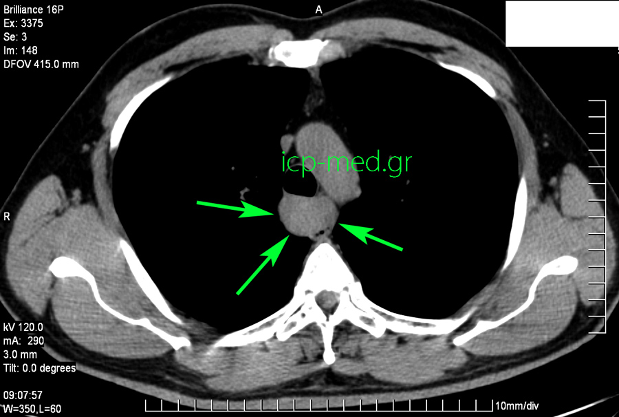 8.Preop CT