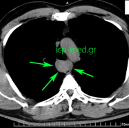 oesophagleiomyoma8.jpg