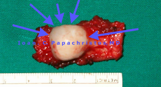 1. Blue arrows: the resected osteochondroma