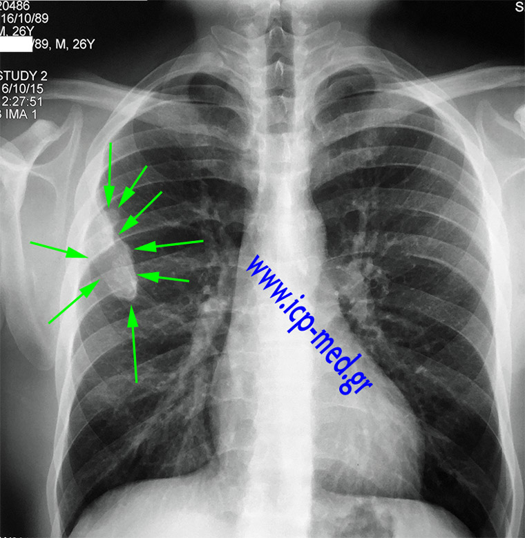 2. CXR (pre-operative)