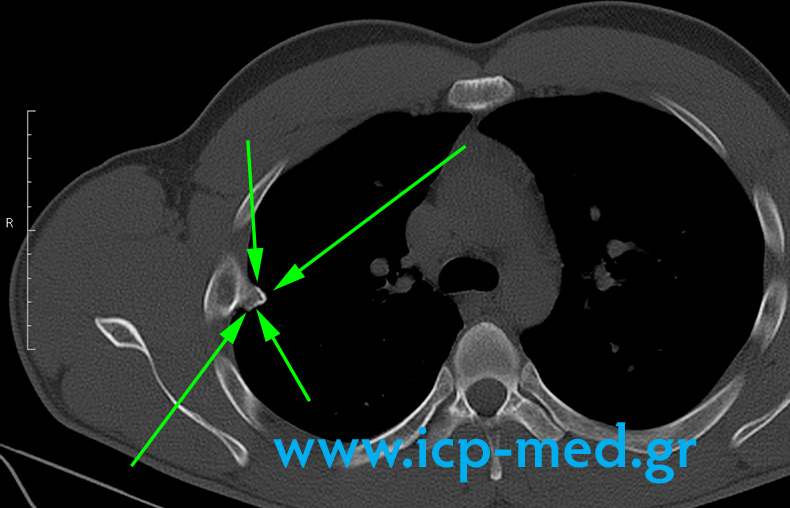 3. Preop CT: green arrows: tumour