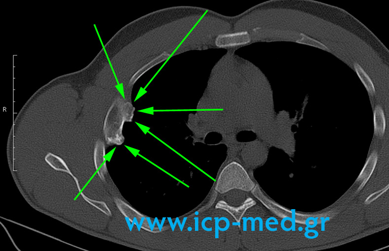 4. Preop CT: the irregularly–shaped tumour