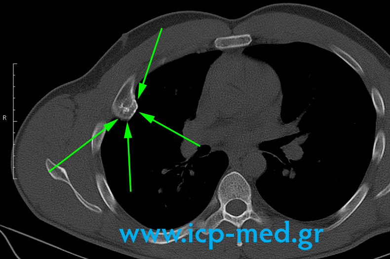 5. Preop CT