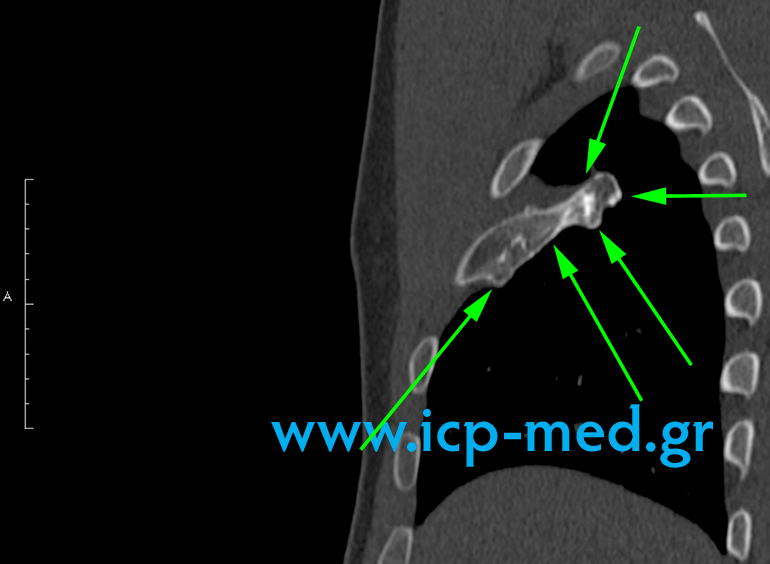 8. Preop MRI (sagittal view)
