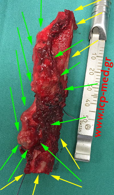 11. The resected tumour (green arrows)