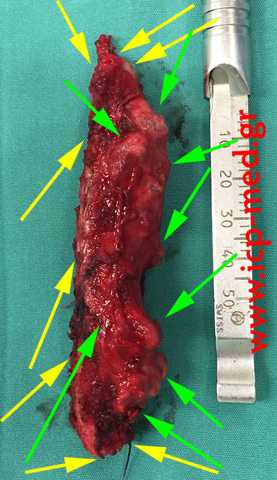 12. The resected tumour (green arrows)