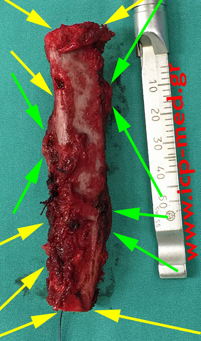 13. The resected tumour (green arrows)