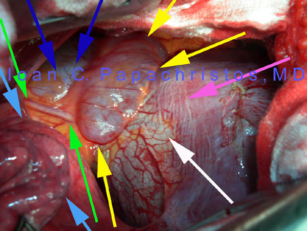 1.YELLOW: Pericardial Diverticulum. GREEN: Phrenic nerve. DARK BLUE: Pericardium. LIGHT BLUE: Pulmonary RLL. PURPLE/WHITE: diaphragm