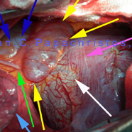 pericardialcyst01.jpg