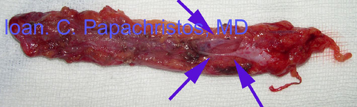 2.Specimen of Pericardial Diverticulum resected. BLUE: communication with the interior of the pericardial cavity