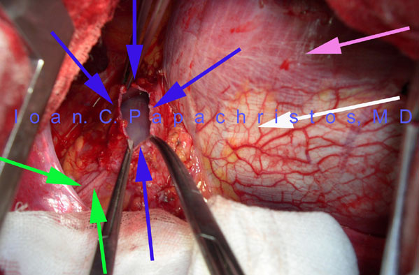 3.Residual pericardial Defect post resection of the Pericardial Diverticulum