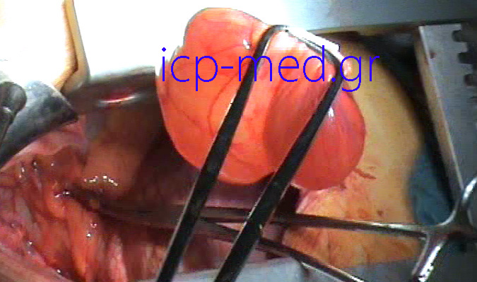 4.Specimen of two confluent Pericardial Cysts resected (two cysts together)