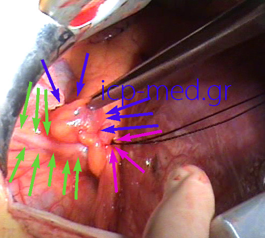 6.Third Pericardial Cyst (BLUE), in contact with the Phrenic nerve (GREEN). PURPLE: the bed of the resected large 2 confluent peric. cysts