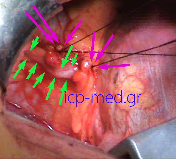 7.GREEN: phrenic nerve. PURPLE: the beds of all 3 resected pericardial cysts