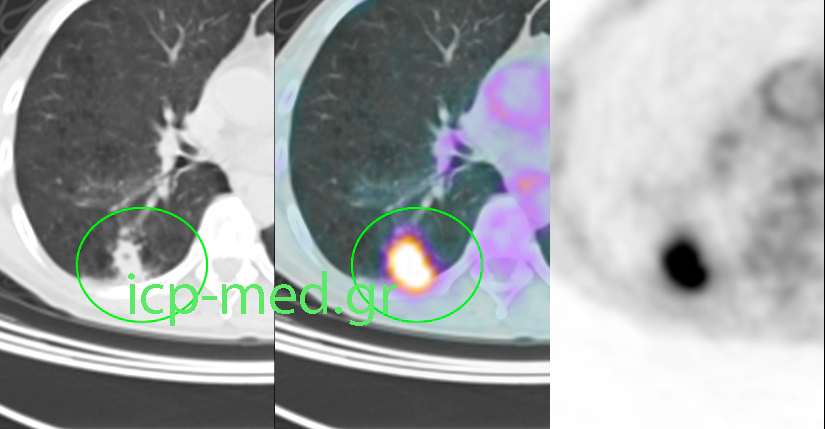 1. Preop PET/CT (Positron Emission Scanning combined with CT) in a 50-yo male smoker: solid mass of the right lung