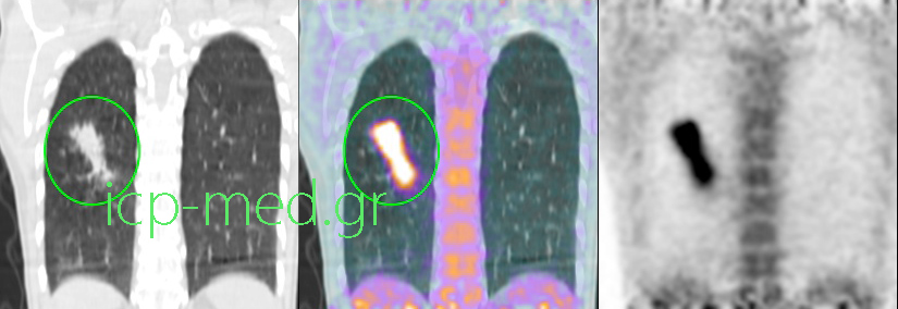 3. Preop PET/CT (coronal view) of a solid mass in the RLL, intensely hypermetabolic (SUVmax 12)