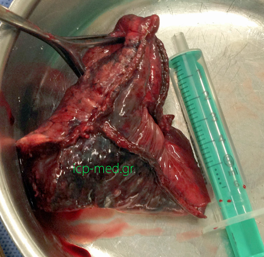 5.Specimen (measuring 7.5 x 5.5 x 4.8 cm) of wedge resection of the lesion, directly compared against a standard 5 ml syringe