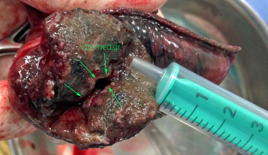 6. Specimen transected: cavity shown in its interior (pulmonary tuverculosis mimicking tumour)