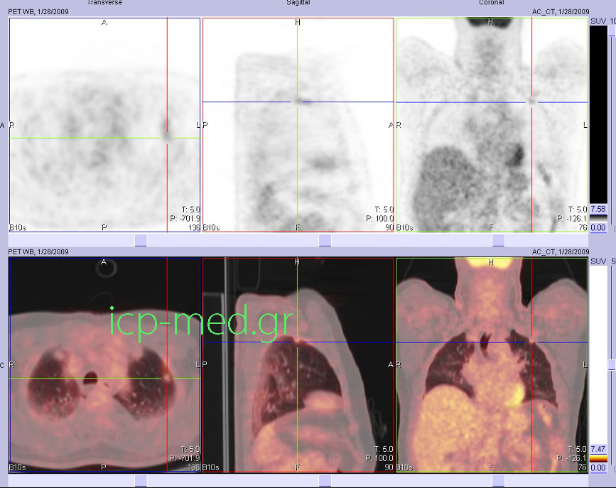 7. Preop PET/CT (Positron Emission Tomography associated with CT) in a 72-yo male smoker: solid mass of the left lung
