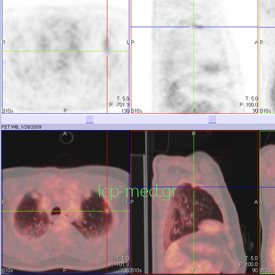 8. Preop PET/CT of the hyermetabolic lesion  (measuring 1.1. cm) of the pulmonary LUL. Postop diagnosis: TBC