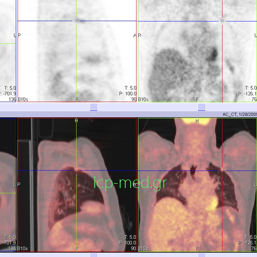 9. Preop PET/CT of the LUL lesion (measuring 1.1 cm), that was very suspicious for (mimicking) malignancy; final postop diagnosis:TBC