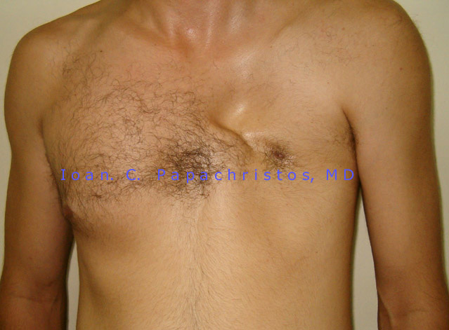 The left nipple is visible, however the left pectoralis major muscle is NOT at all (normal anatomy on the right side)
