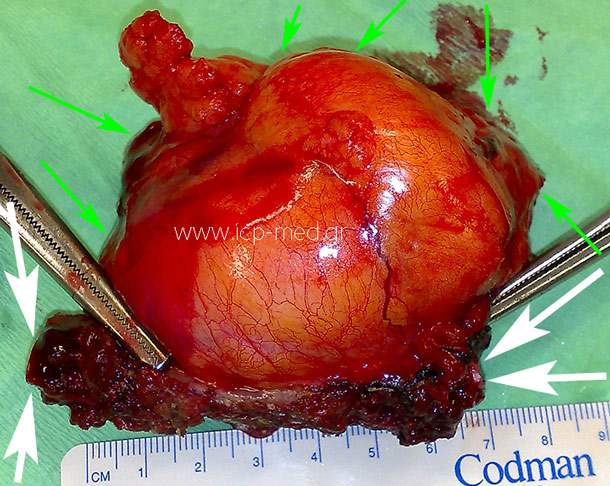 Specimen of the rib's tumour, resected