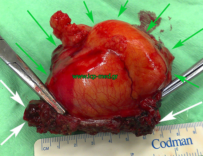 Specimen of the rib's tumour, resected