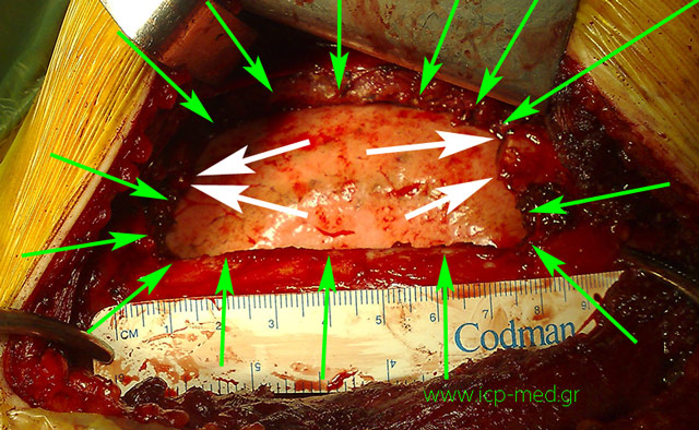 The residual Chest Wall DEFECT