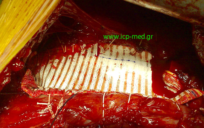 The RECONSTRUCTION of the Defect by using a PTFE prosthesis