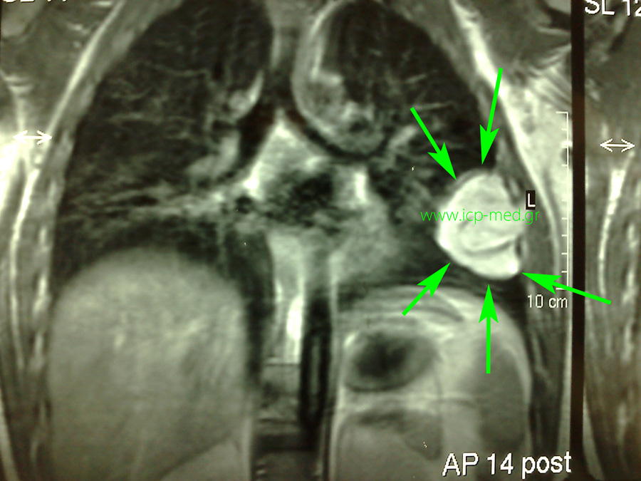 Preop MRI. Green arrows: tumour