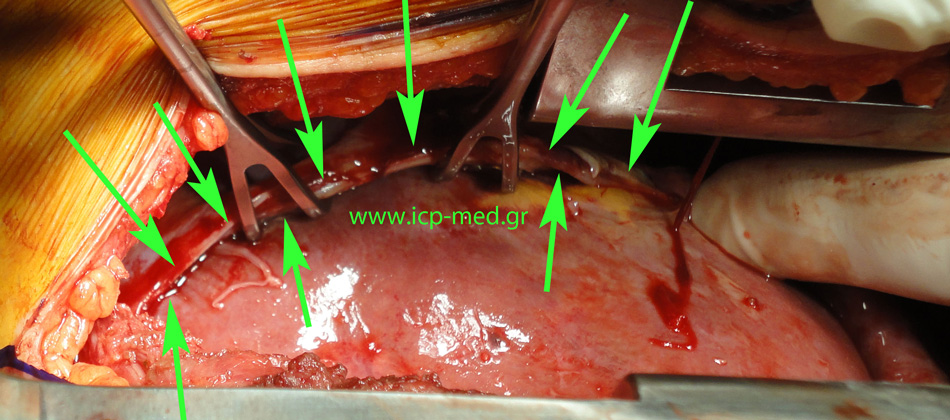 GREEN arrows: rupture of the right hemidiaphragm