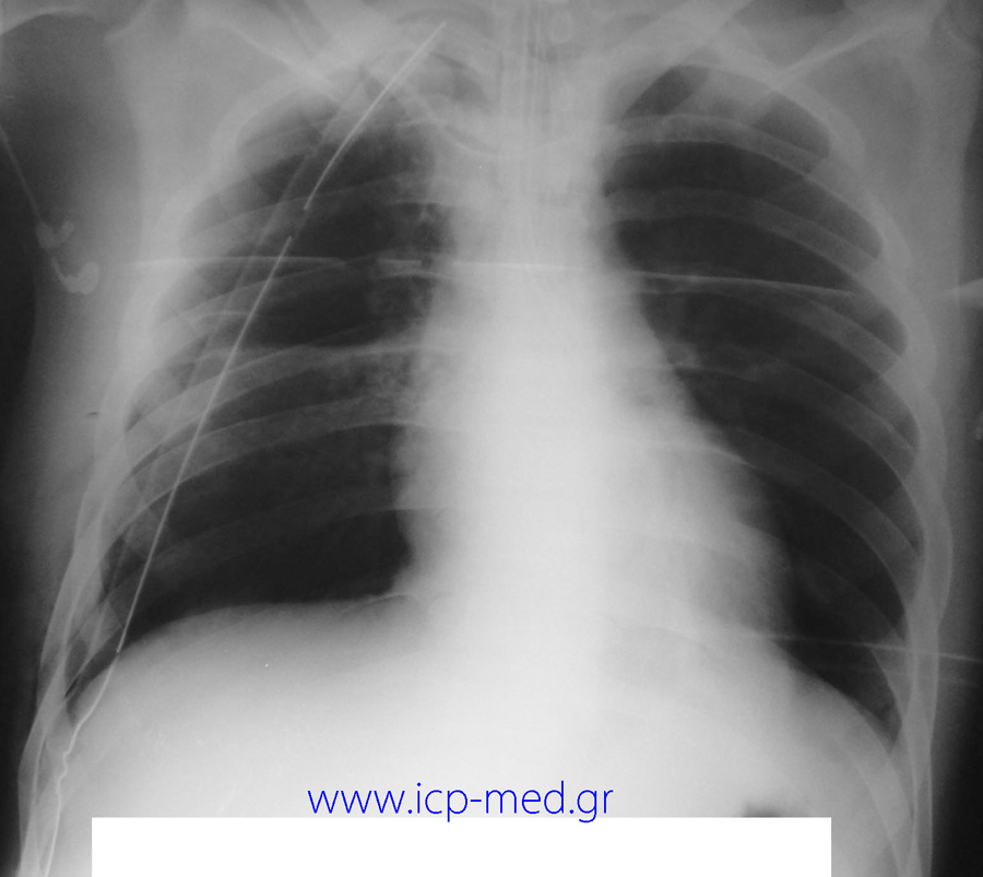 Early postop CXR