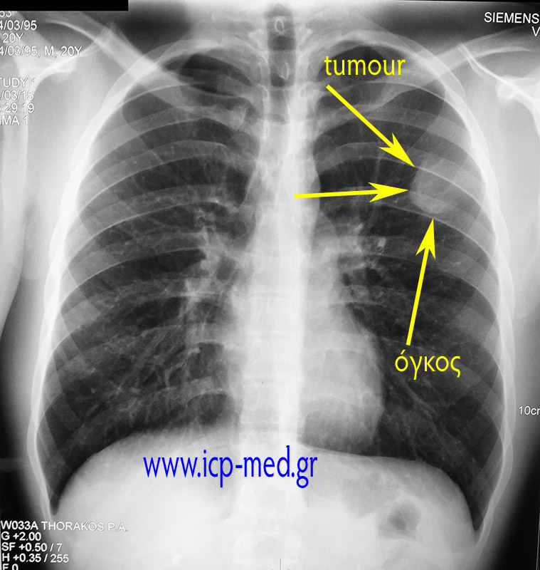 1. Preop CXR (posteroanterior) upon admission