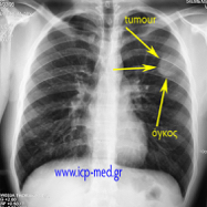 sarcomamyofibrobl01.jpg