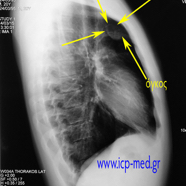 sarcomamyofibrobl03_c.jpg