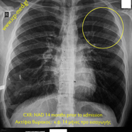 sarcomamyofibrobl02.jpg