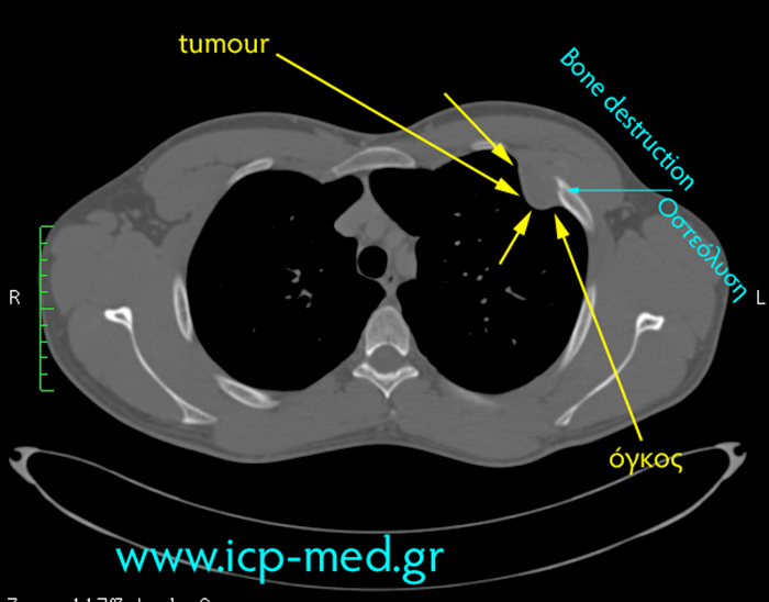 4. Preop CT scan (cyan arrows: the contact between the tumour & the 3rd rib)