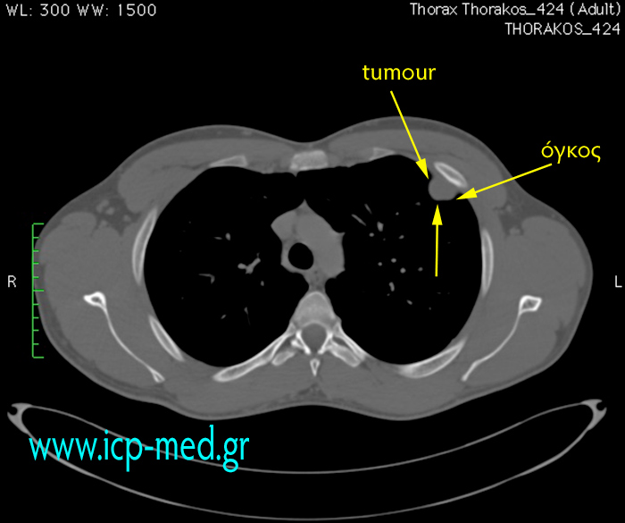 5. Preop CT scan