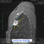 sarcomamyofibrobl07.jpg