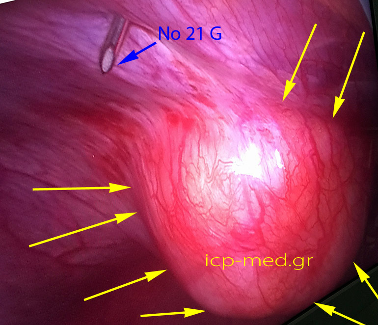 10. Intraop photo: the tumour's margins are found by VATS, then marked (by № 21 G needles)