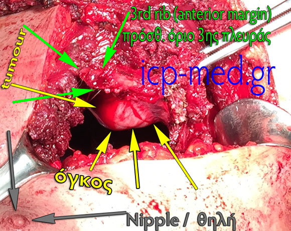11. Intraop photo of the redical resectional procedure (Chest Wall Resection)