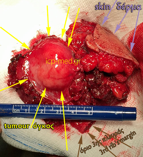 12. The finally resected specimen of the tumour along with its overlying muscular & skin tissues involved.