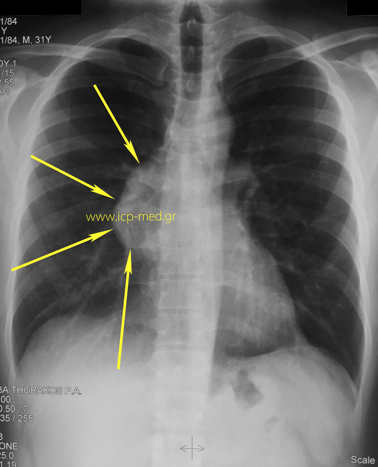 1.Preop CXR: the Seminoma appears as Confluent to the heart silhouette (right side)