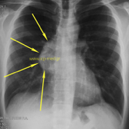 seminoma01.jpg