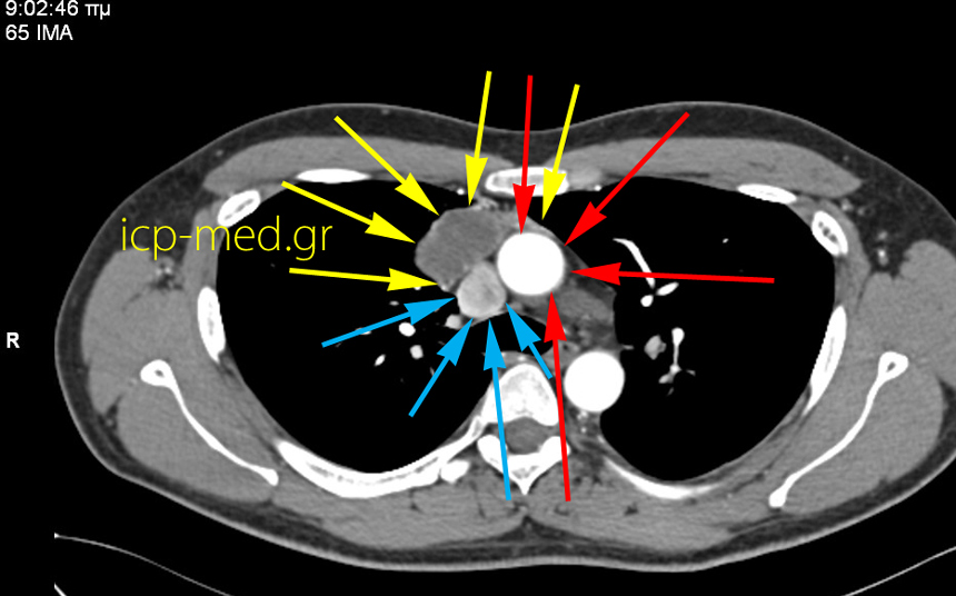 2.CT: the Seminoma abuts the SVC & the Ascending Aorta