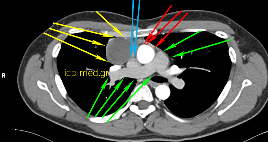 3.CT: the Seminoma abuts the SVC & Ascending Aorta